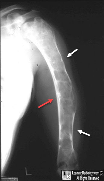 Fibrous Dysplasia. There are expansile, geographic, lytic lesions in the shafts of the 3rd metacarpal and proximal phalanx of the middle finger (red arrows). They have a characteristic "ground-glass" appearance to their internal matrices. Enchondromas can have a similar appearance though their internal matrix would be more coarse, resembling rings and arcs.